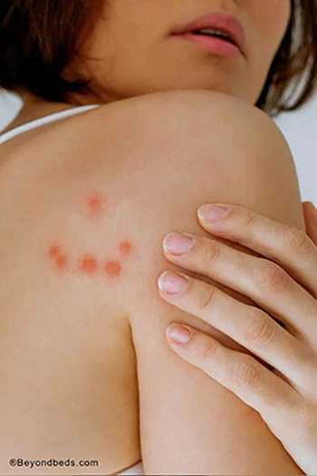 A woman’s back and shoulder showing multiple red, inflamed bed bug bites on her skin. Eradizyme to rid bed bugs