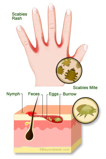 Illustration of a hand with a scabies rash and burrowing scabies mites beneath the skin.